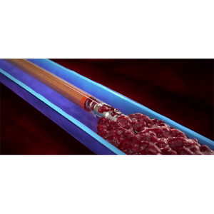 Aspirex